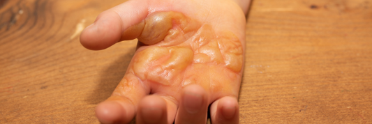 How to Heal a Burn Quickly: The 4 C's of First Aid to Reduce scarring