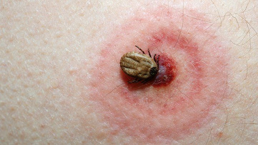 How to Safely Remove a Tick